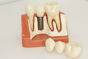 抜歯後の処置について