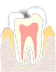 エナメル質内の虫歯