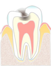 象牙質に達した虫歯