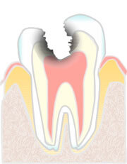 象牙質に達した虫歯