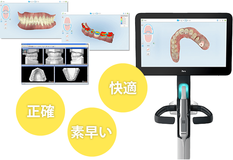 口腔内光学スキャナー iTero