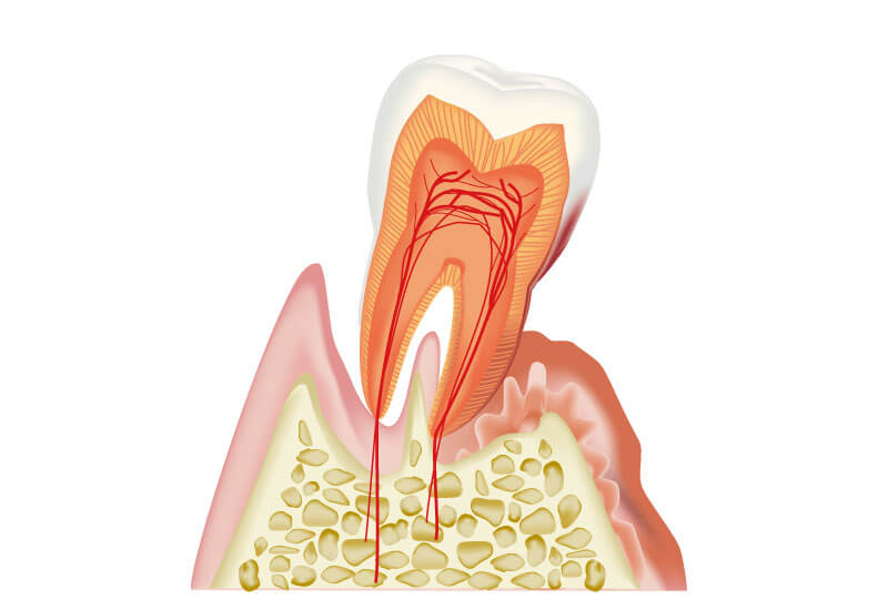 歯周病治療
